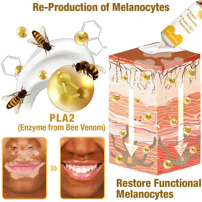 Crema tratamiento de vitiligo con veneno de abeja - Fivfivgo