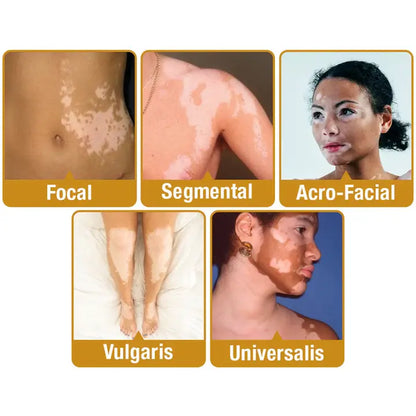 Crema tratamiento de vitiligo con veneno de abeja - Fivfivgo